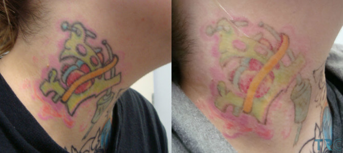 Tattoo Removal Cost Tattoo Removal Cost