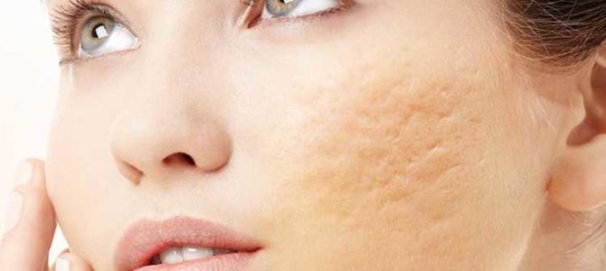 A General Study on Acne Scar Removal Surgery