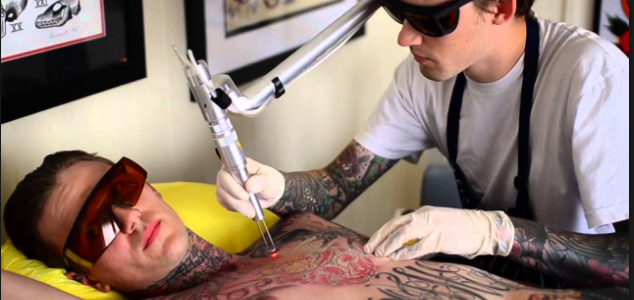 TATTOO REMOVAL GOLD COAST TATTOO REMOVAL GOLD COAST