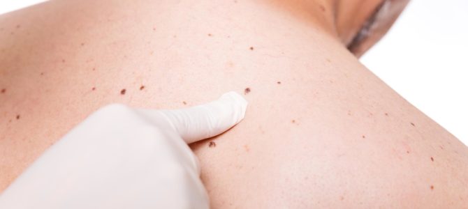 The Prevention Of The Skin Cancer The Prevention Of The Skin Cancer