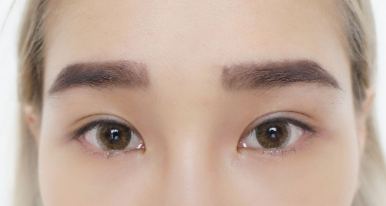 Get a youthful look with an eye lift