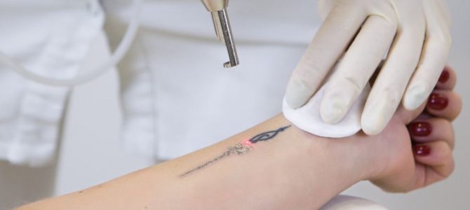 Things you do not know about laser tattoo
