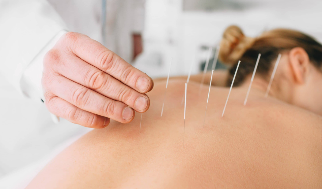 Acupuncture Treatment