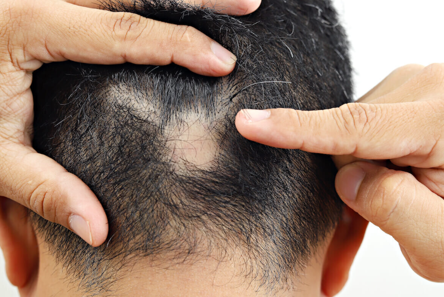 5 Amazing Benefits of Hair Loss Treatment in NZ You Probably Didn’t Know 5 Amazing Benefits of Hair Loss Treatment in NZ You Probably Didn’t Know