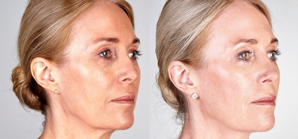 5 Best Skin Tightening Treatments that Really Work: