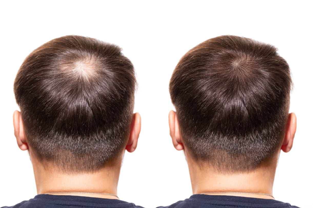 Medically-proven Tips for Effective Hair Loss Treatment Medically-proven Tips for Effective Hair Loss Treatment