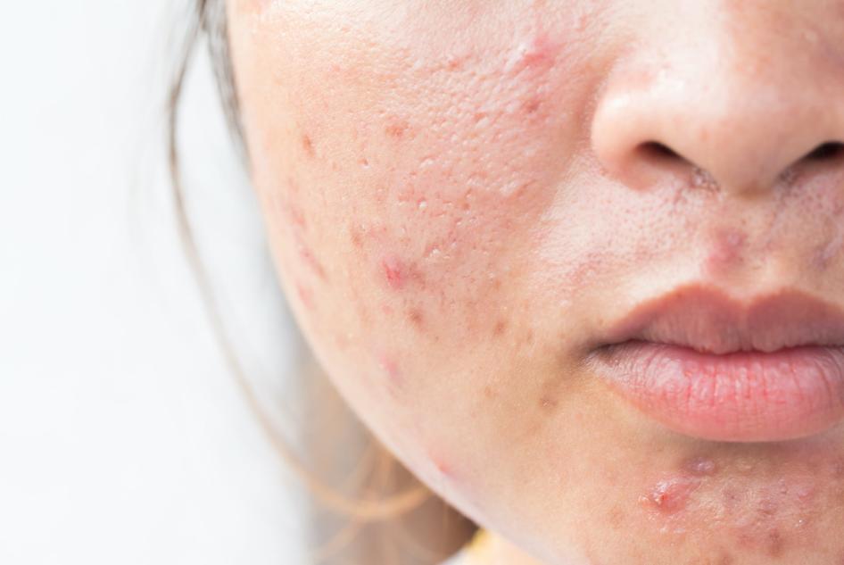 Mistakes to Avoid When Visiting an Acne Treatment Centre Mistakes to Avoid When Visiting an Acne Treatment Centre