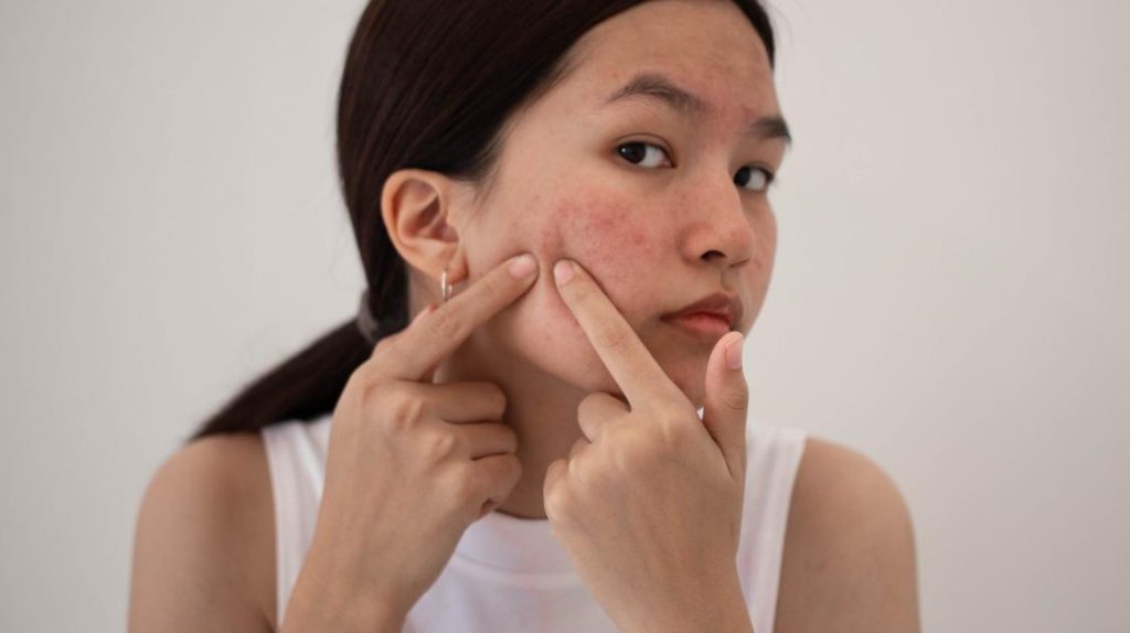 acne treatment centre